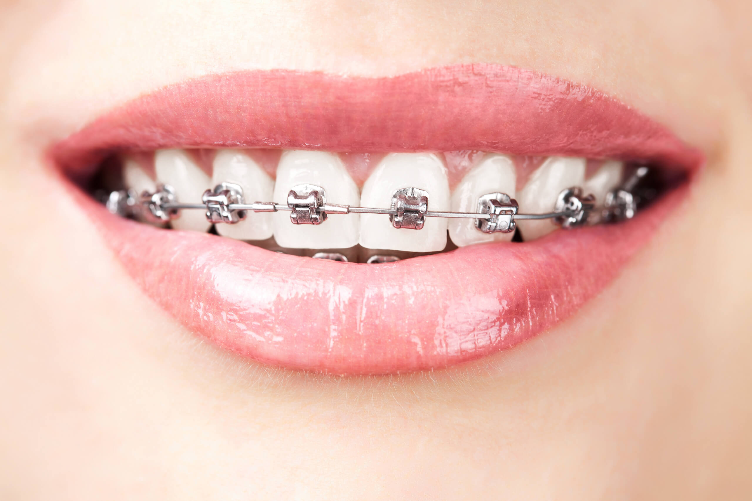 Lächelnder Mund mit fester Zahnspange